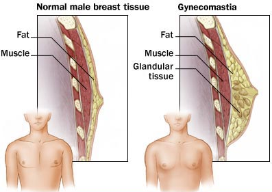 gynecomastia.png