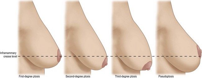 breast ptosis.jpg