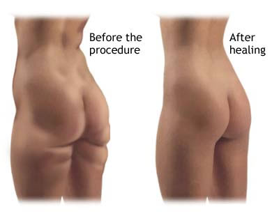 liposuctioncyprus.jpg