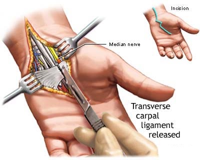 carpal tunnel.jpg