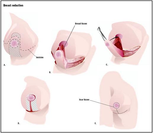 breast reduction limassol