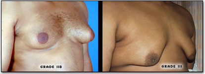 male breast enlargment cyprus.png