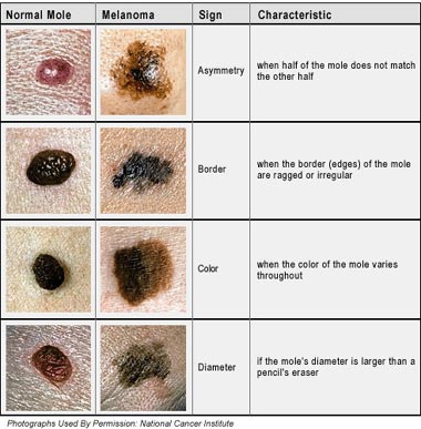 skin cancer cyprus.jpg